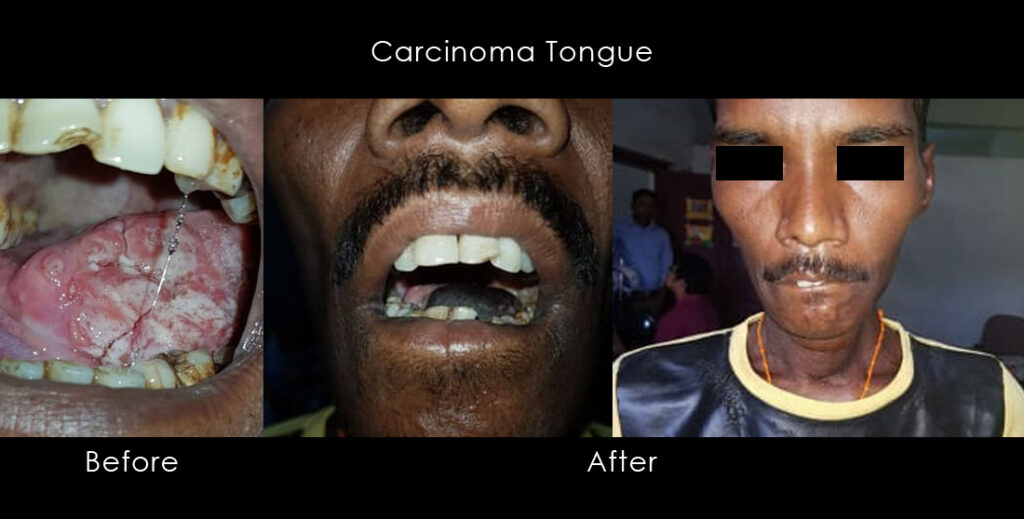 Carcinoma-Tongue