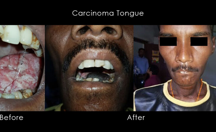 Carcinoma-Tongue